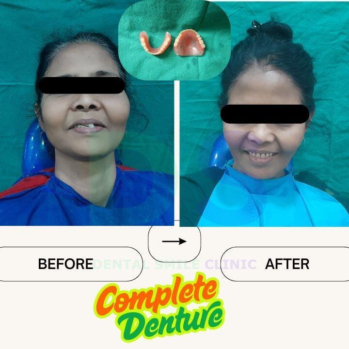 Complete denture treatment