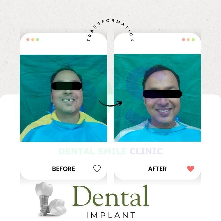Dental Implant treatment