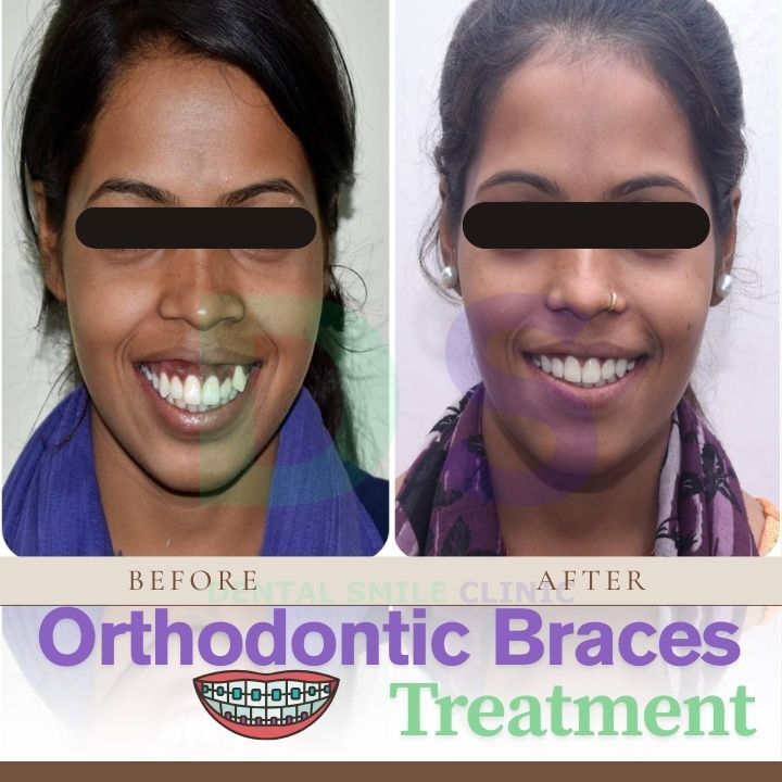 Orthodontic braces