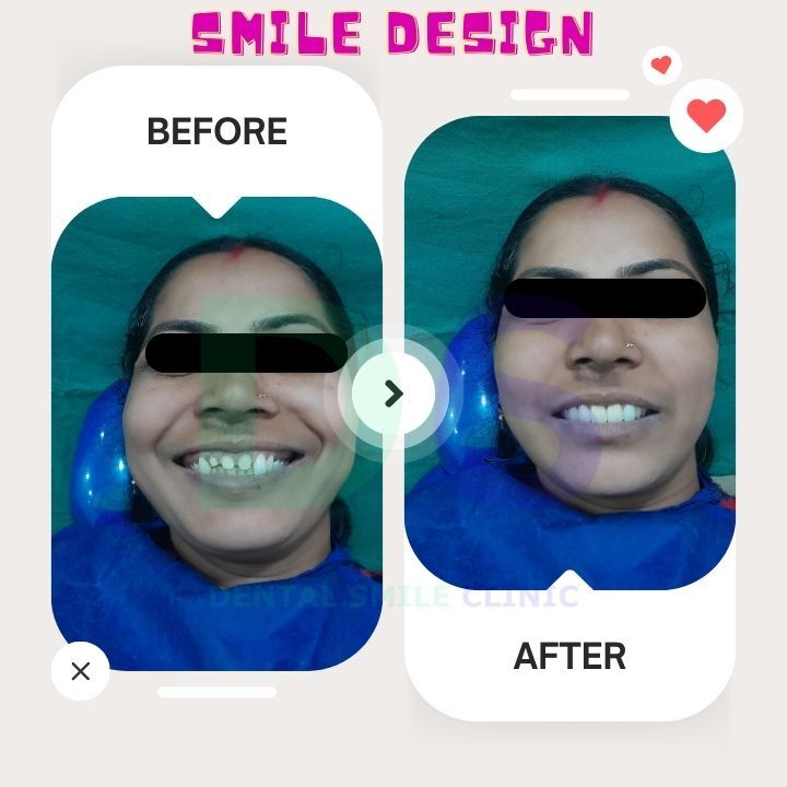 Smile design