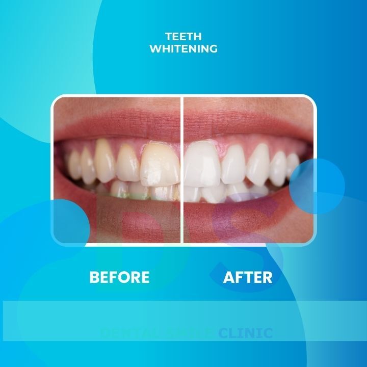 Teeth whitening treatment
