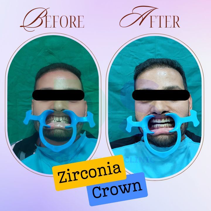 Zirconia dental crown