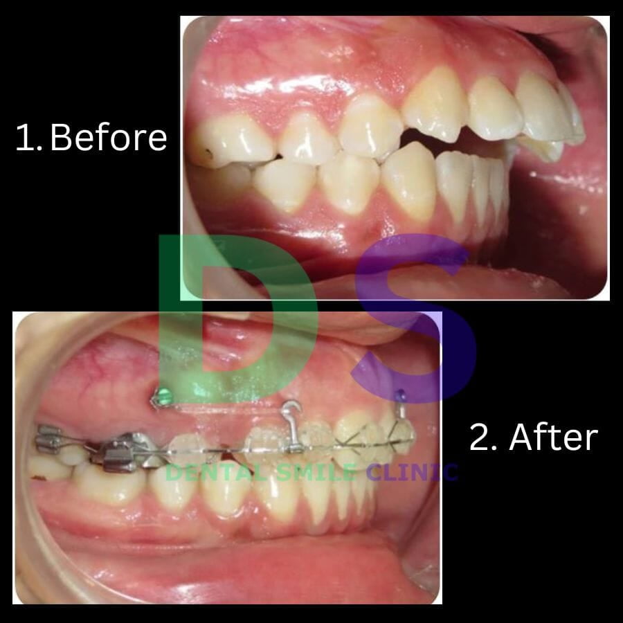 Orthodontic braces protruded teeth treatment.