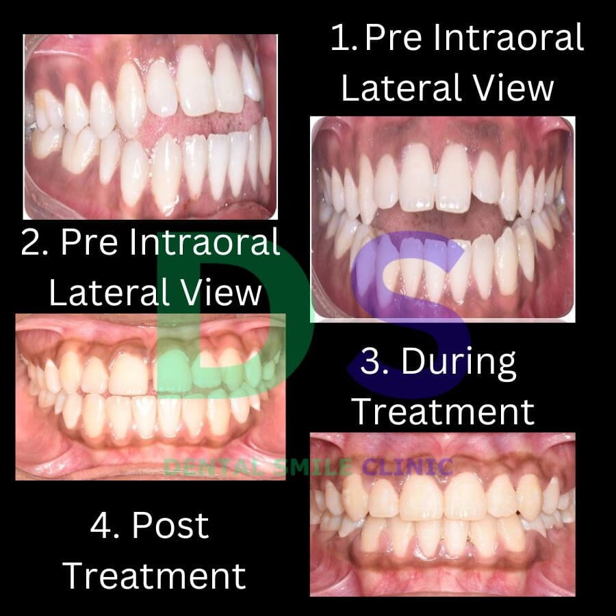 Open bite braces treatment.