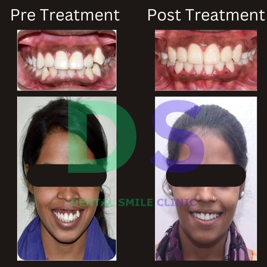 Intraoral and extra oral views of smile design transformation.