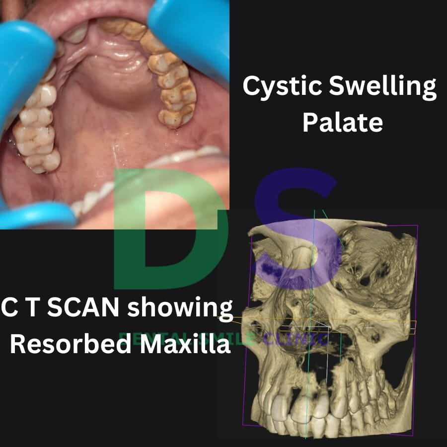 Swelling of the maxillary palate indicates the presence of a cystic lesion.