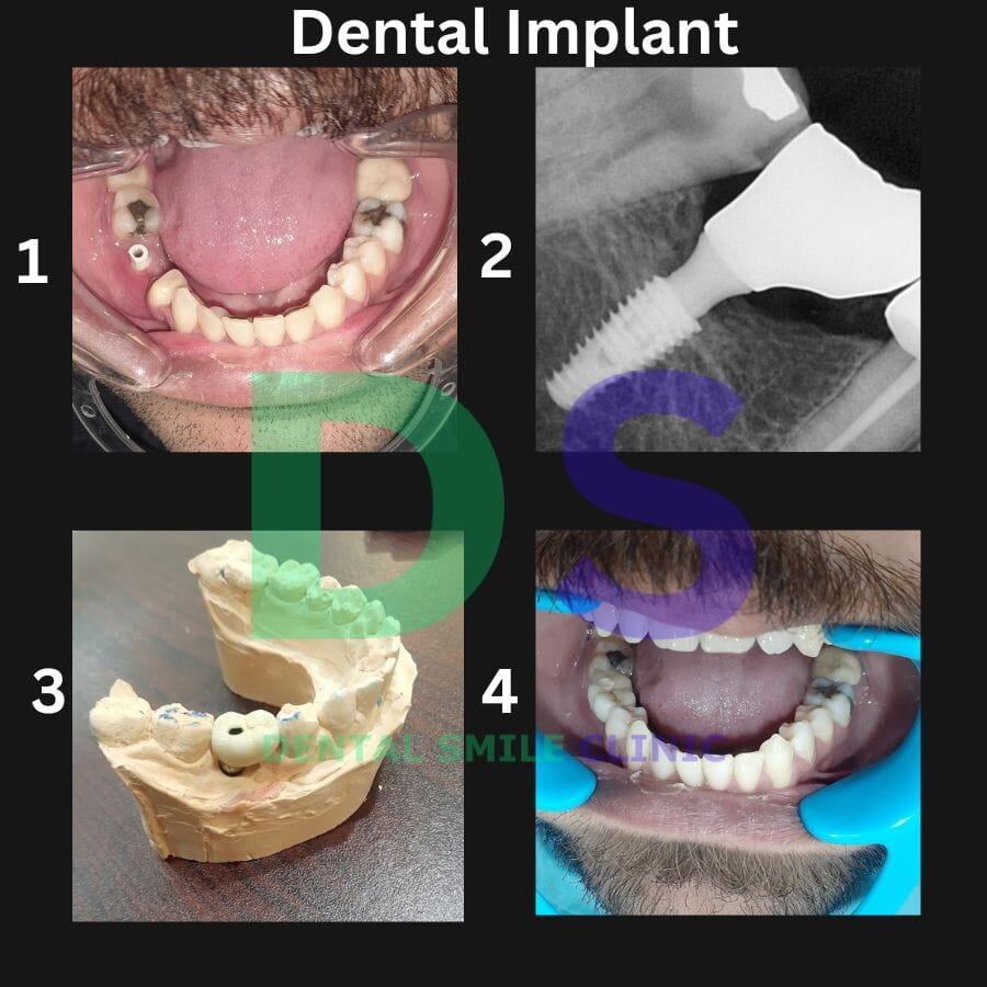 The process of dental implant treatment conducted by prosthodontics involves a series of steps.