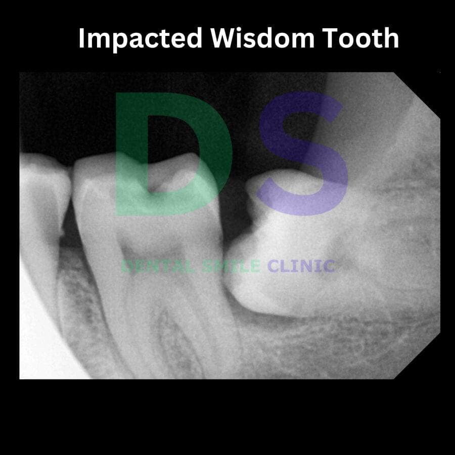 Dental x-ray showing impacted third molar or wisdom tooth.