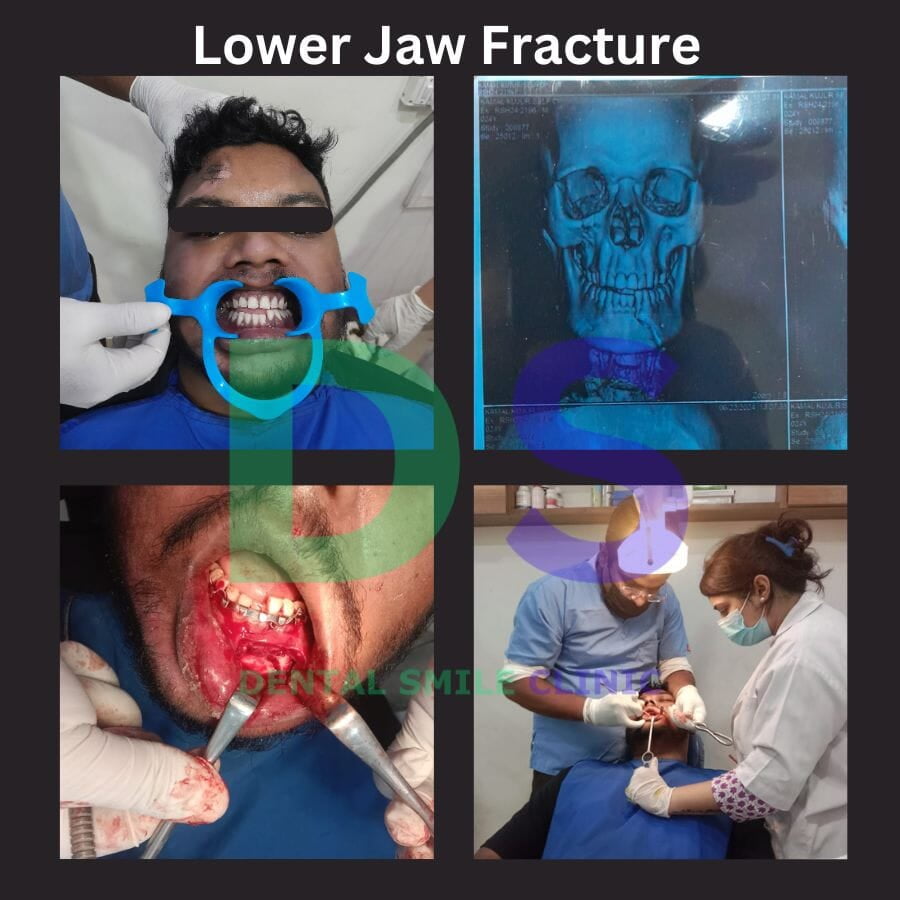 Lower jaw fracture done by maxillofacial surgeon.