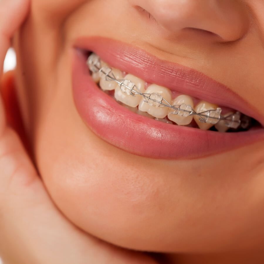 A woman smiling with ceramic braces