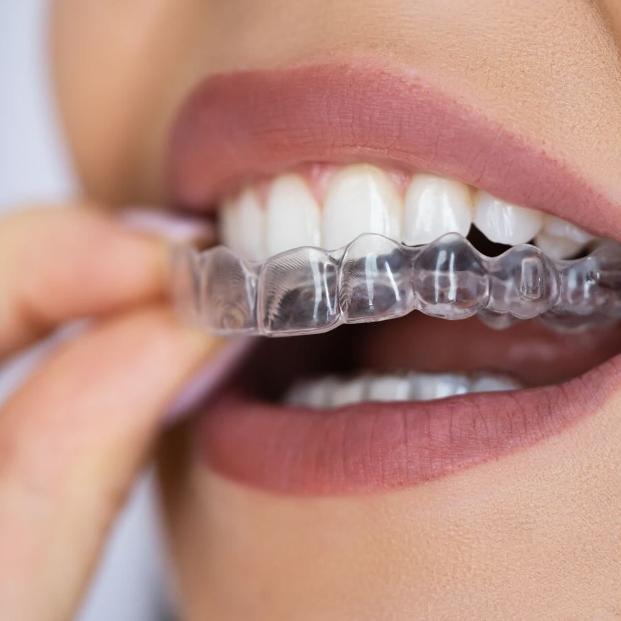 clear aligner is being worn by patient to correct teeth alignment.