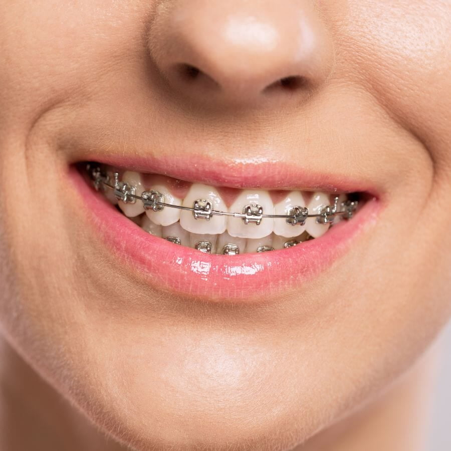 A patient wearing metal braces smiling confidently.