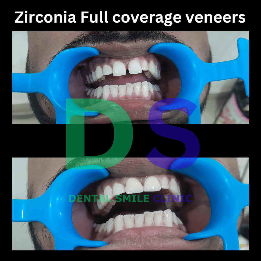 Image depicting zirconia veneers, showcasing the results before and after treatment by a dental professional.