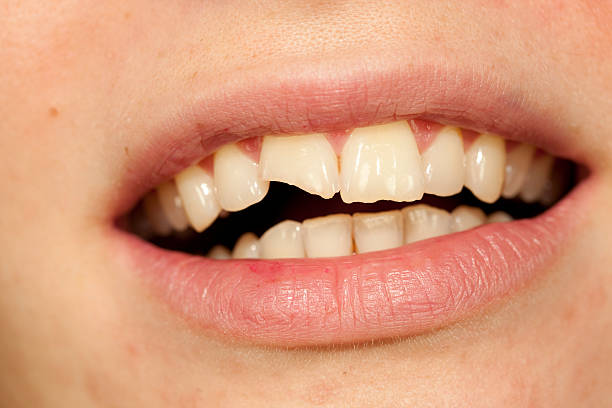 Traumatized Discolored Tooth Management